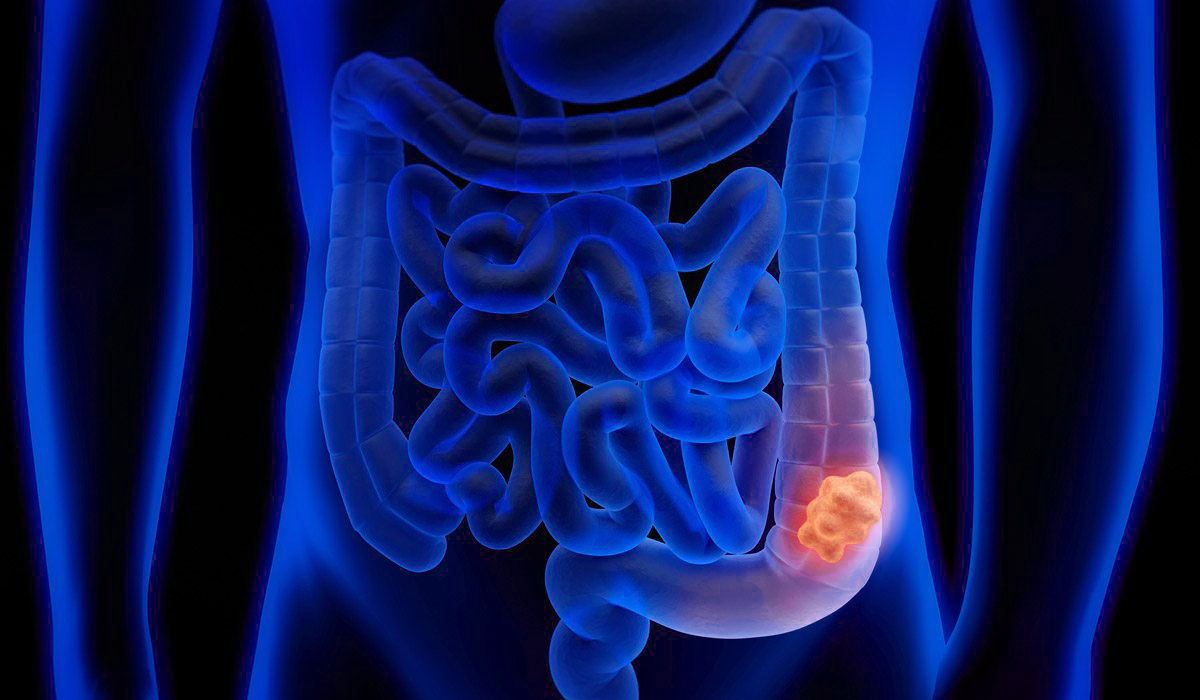 Especialistas comparten su preocupación por el alza en el cáncer de colon en personas menores de 50 años